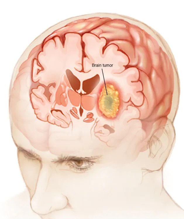 Brain Tumors: All You Need to Know